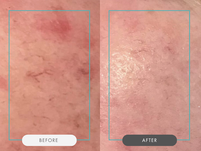 Prime & Peel Before and after 2